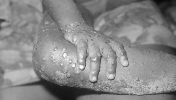 La variole du singe signalée au Burundi : Les épidémiologistes appellent à plus de mesures concrètes